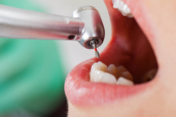 Best Knocked-Out Tooth (Avulsed Tooth) Treatment in Larch Y, WA